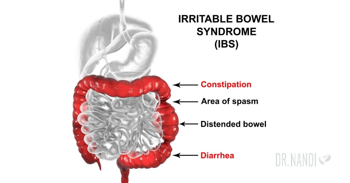 how-does-ibs-affect-the-quality-of-life-gut-health-ask-dr-nandi