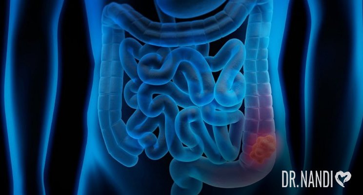 Colorectal Cancer: Symptoms, Causes, And Treatment
