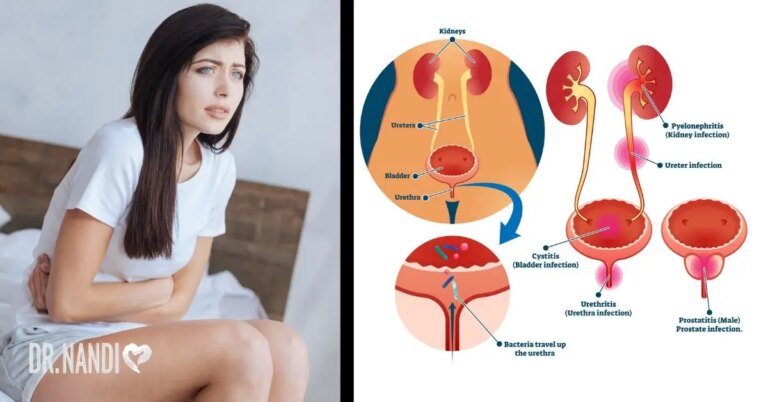 Urinary Tract Infection (UTI): How to Prevent and Heal