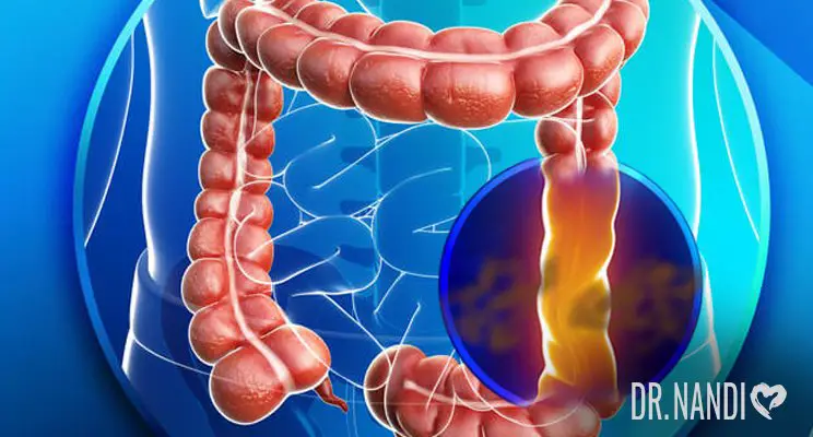 Leaky Gut Syndrome: Signs, Causes, and Treatment