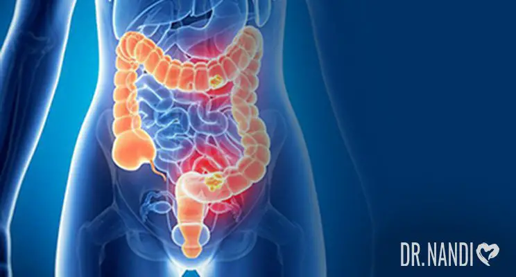 What is IBD? Symptoms, Causes, and Cure