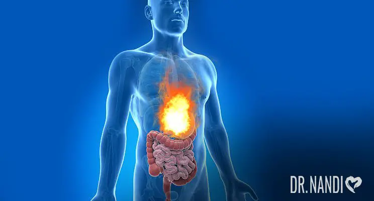 What You Should Know About Acid Reflux or GERD