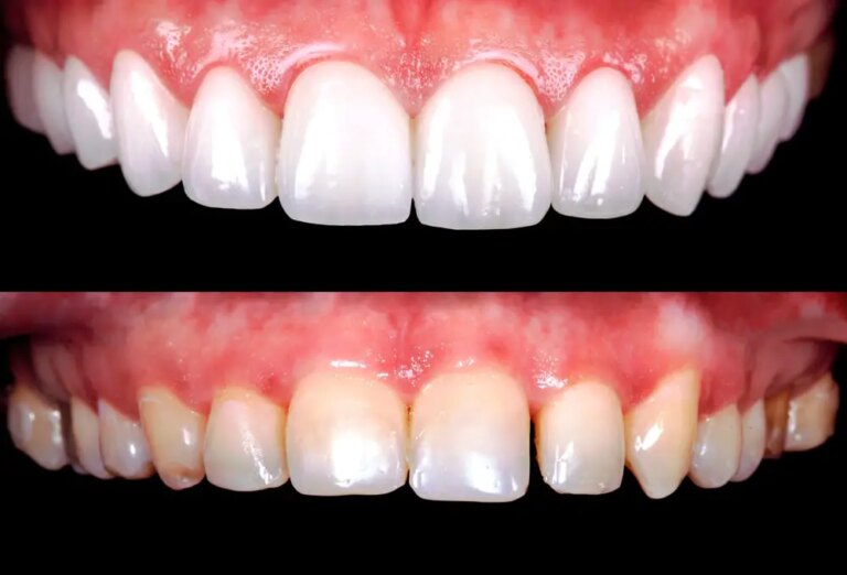 4 Easy Teeth Whitening Strategies