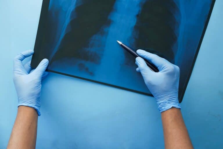 Breakthrough: Lung Cancer Vaccine Enters Clinical Trials in Seven Countries