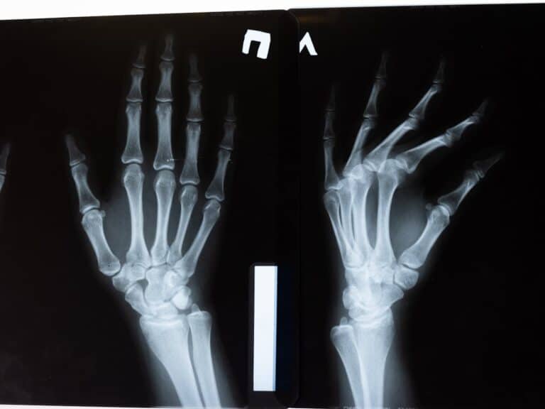 European Joint Pain Treatment Passes Major Scientific Test