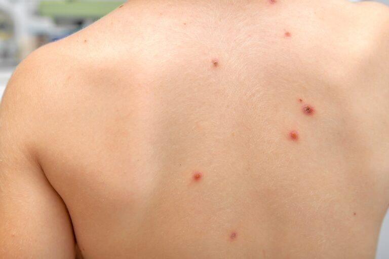 What Tiny Red Dots on Your Skin Might Reveal About Your Health
