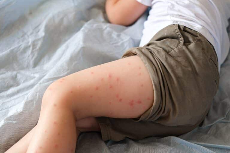 Measles Spreads Faster Than Ebola, COVID, and Smallpox Combined