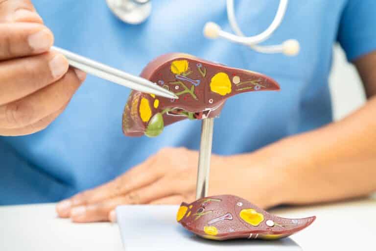Too Much Body Fat Quietly Leads to Gallstones