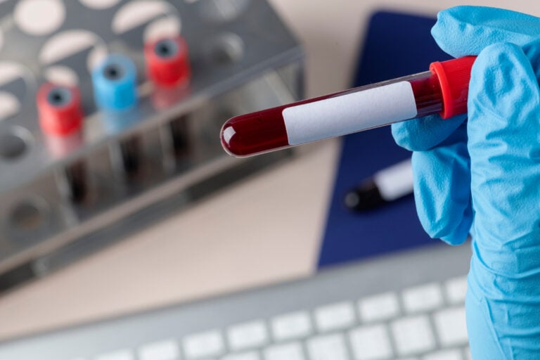 Researchers Question Whether Alzheimer’s Proteins Can Spread Through Donated Blood